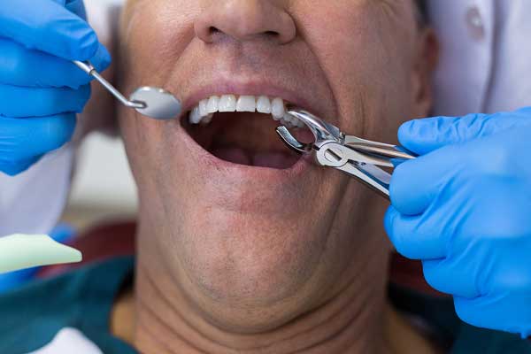 Tooth extraction - Dental Infection