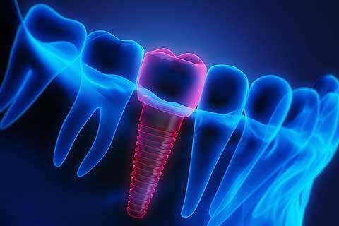 Implant Dentist in Forest Hill, Vic 3131