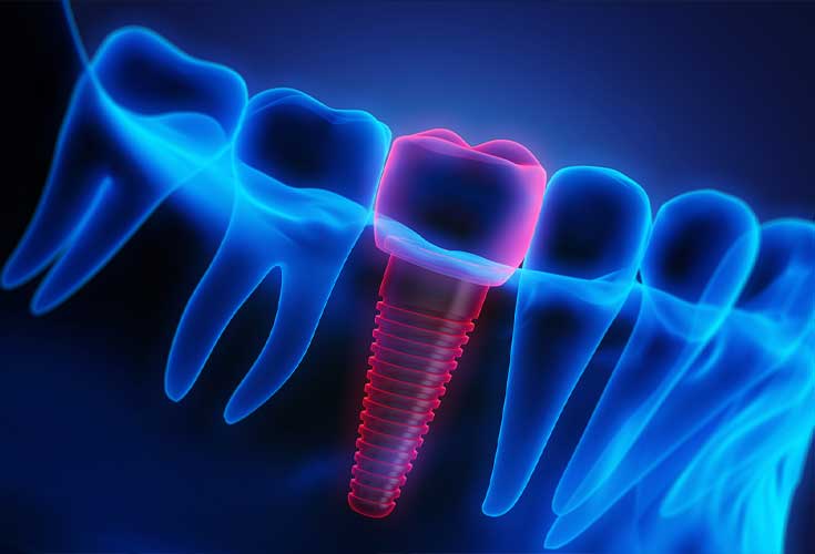 Single Tooth Implant at Forest Hill Dental