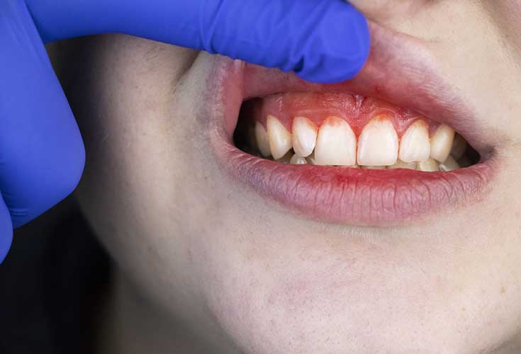 Bleeding Gums Treatment | Dental At Forest Hill