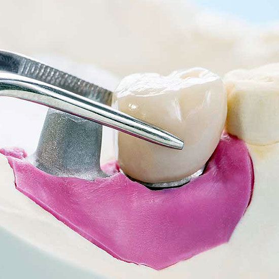 CEREC crown uses Computer-Aided Design (CAD) and Computer-Aided Manufacturing (CAM) to create crowns in a single appointment.