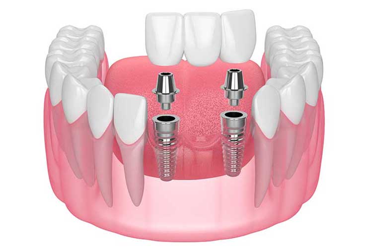 Implant Supported Dentures