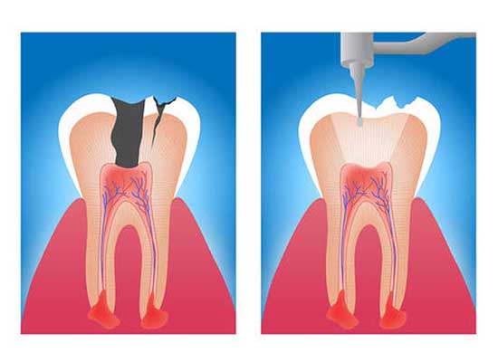 Root canal treatment