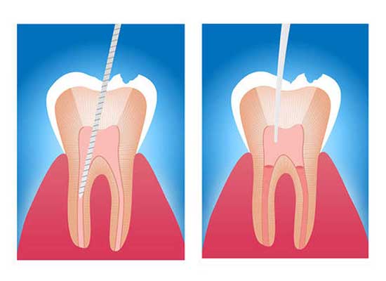 Root canals