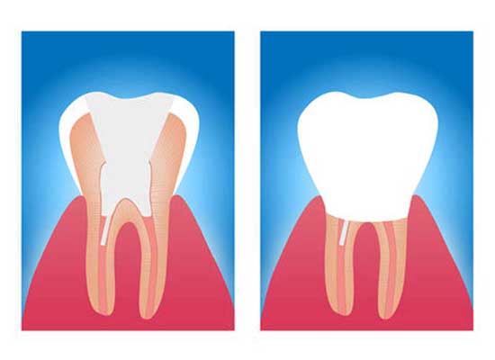 Root canals