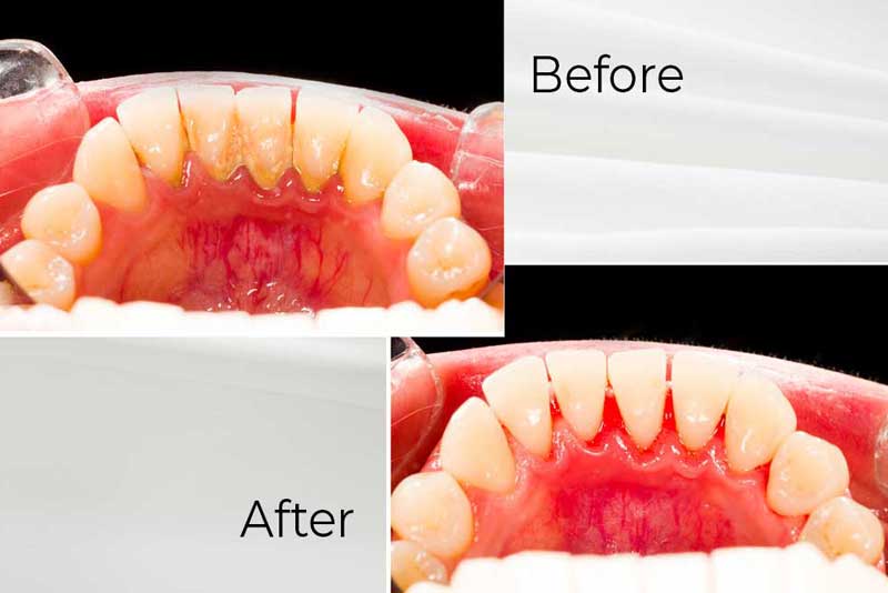 Scaling & Oral Hygiene