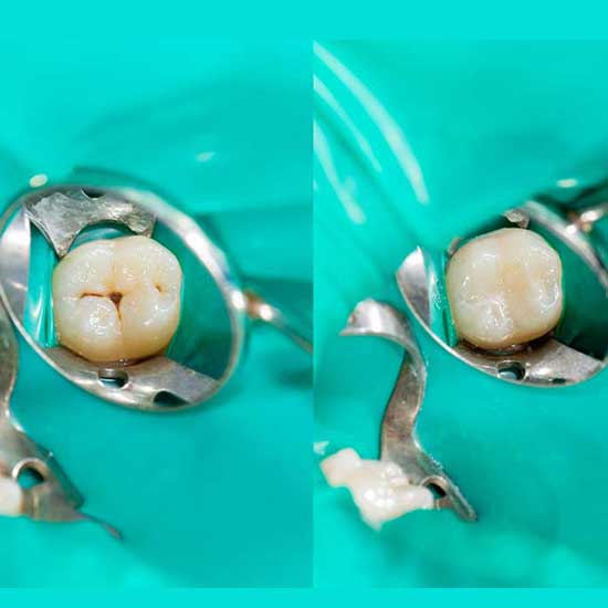 Tooth Colored Fillings