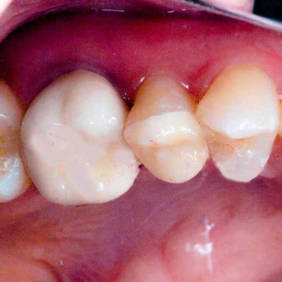 Tooth Colored Fillings