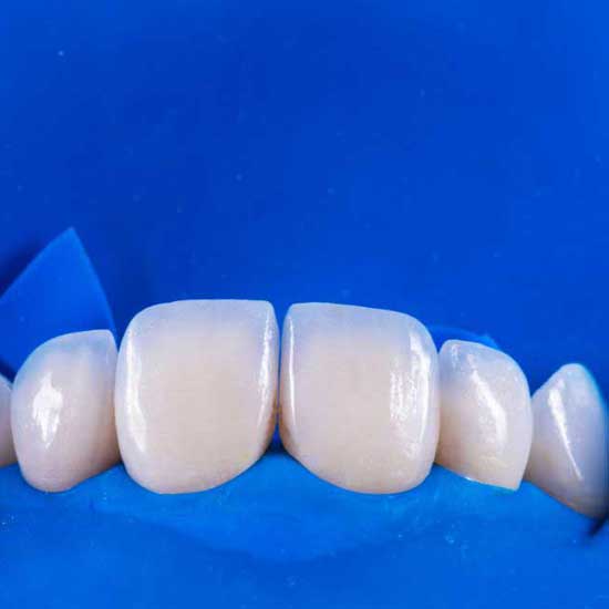 Composite & Porcelain Veneers / Laminates