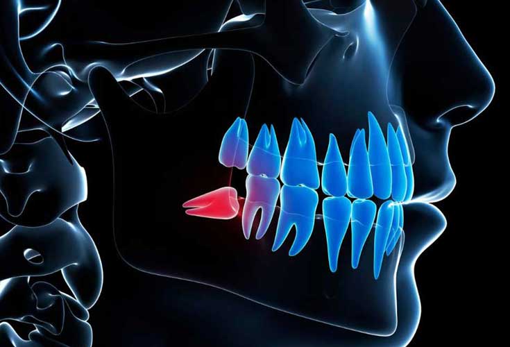 Wisdom Teeth Removal