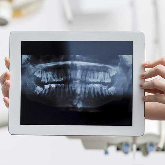 Impacted wisdom teeth