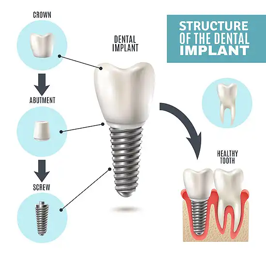 Implant Structure