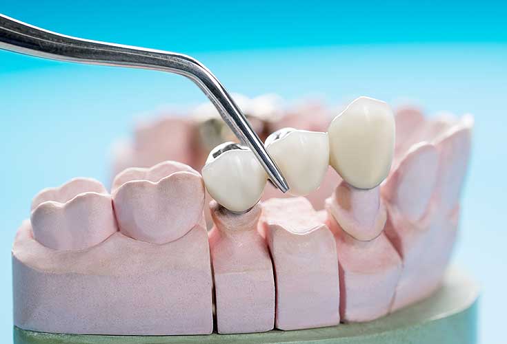 Dental Implants vs. Dental Bridges: Which One Should You Choose?