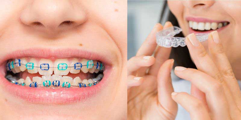Which is Better Invisalign or Braces?