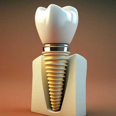 Dental Implants at Forest Hill, Vic