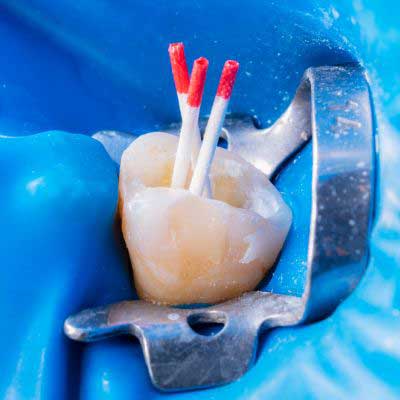 Restorative Dentistry in Forest Hill, Vic