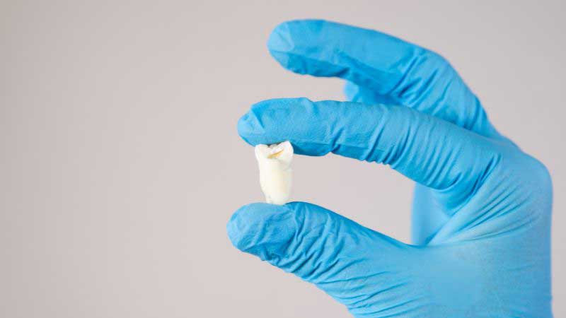 Why It’s Necessary to Replace a Tooth After Tooth Extraction