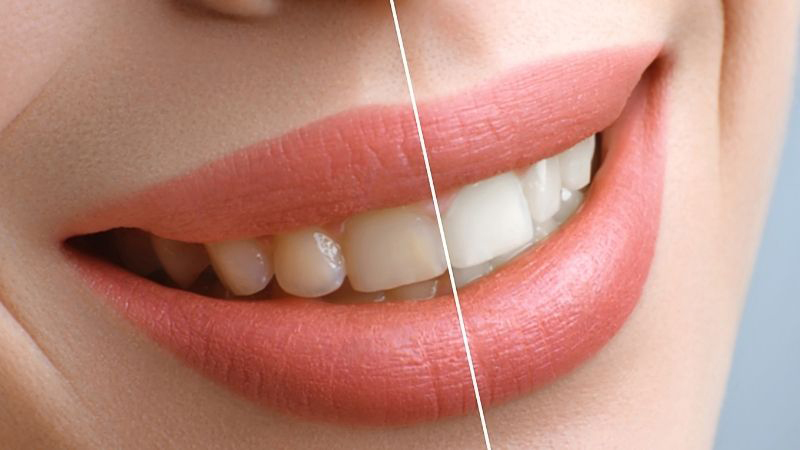 Debunking Teeth Whitening Myths