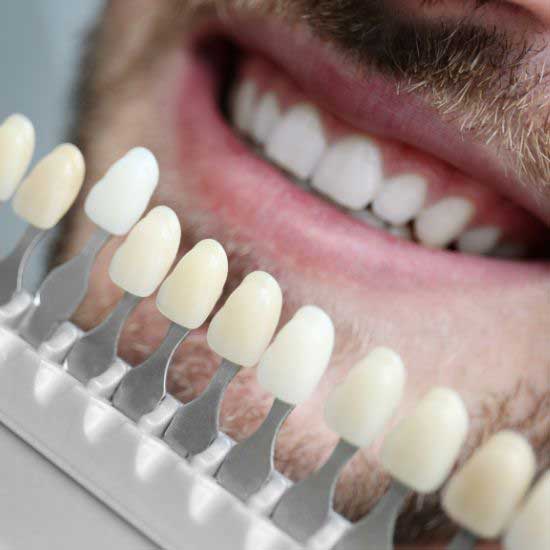 Dental Veneers