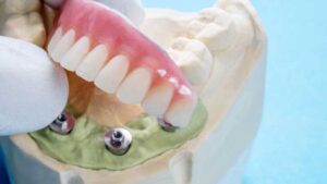 Dental Implants vs Dentures