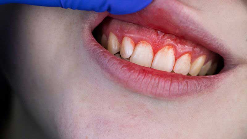 Combatting Advanced Gum Disease