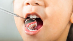 Link Between Cavities and Oral Health