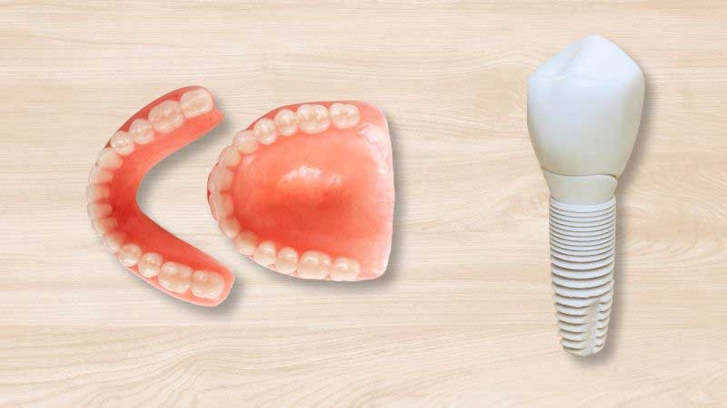 Benefits of Dental Implants