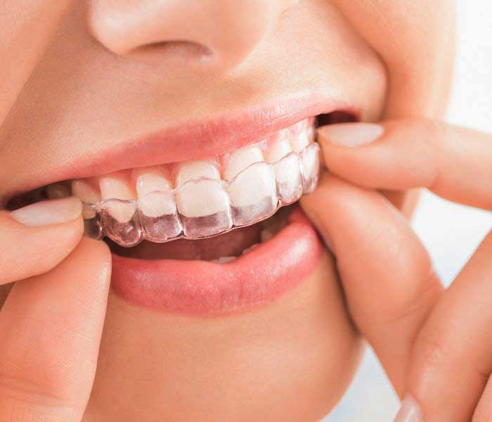 Special Offers - Free Invisalign Consult