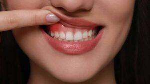 Signs and Symptoms of Gum Disease