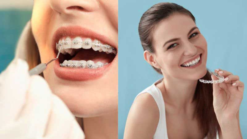 Braces vs Clear Aligners