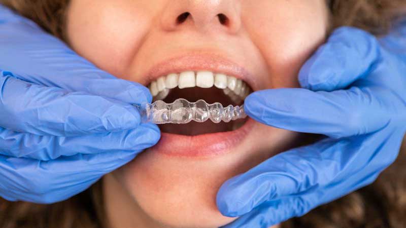 Invisalign: The Clear Path to Straighter Teeth